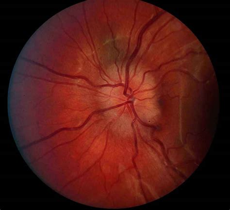 Papilledema causes, symptoms, grades, stages & papilledema treatment