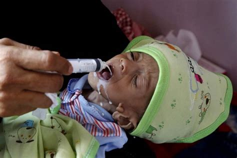 WORLD HUNGER AND MALNUTRITION SOARED IN PANDEMIC-HIT 2020: UN