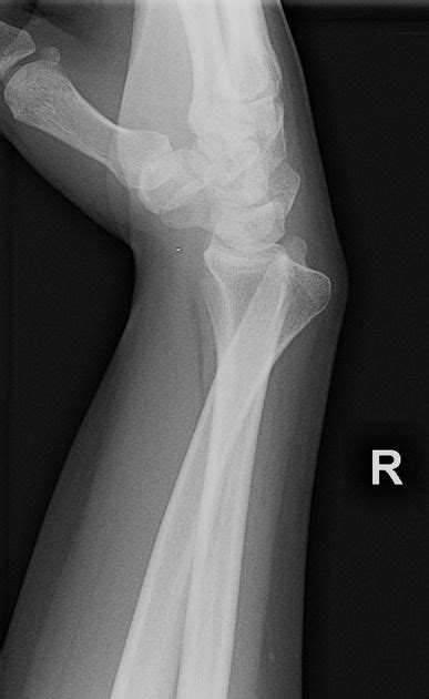 Distal radioulnar joint dislocation – Artofit