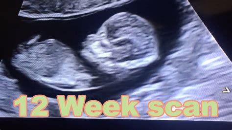 Cute & clear ultrasound of baby Micah | 12 Week scan! - YouTube