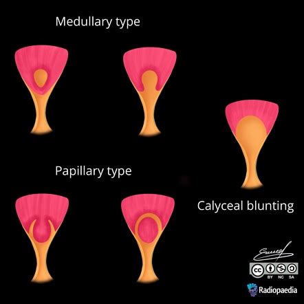 Renal papillary necrosis (diagram) | Radiology Case | Radiopaedia.org