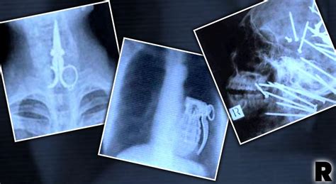 Inside Story! Weird Objects & Horrifying Injuries Caught On X-Ray!