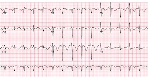 Dr. Smith's ECG Blog: A crashing patient with an abnormal ECG that you must recognize