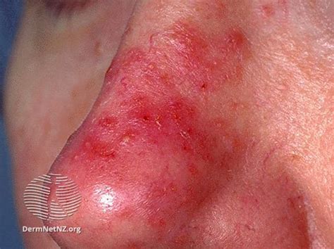 Understanding Rosacea - theGoodSkinPlace