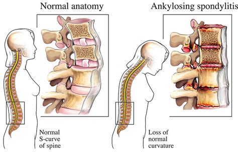 Ankylosing spondylitis, causes, symptoms, diagnosis, treatment & prognosis