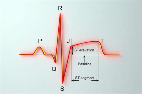 ECG in Myocardial Infarction. Illustration Showing ST Elevation, Labeled Image Stock ...