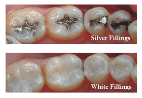 White Tooth Fillings in London | White Fillings Cost | Composite Fillings