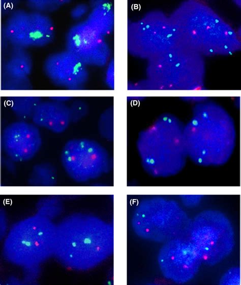 Clinical significance of CD28 gene-related activating alterations in adult T-cell leukaemia ...