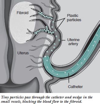 Uterine fibroid tumors : symptoms and treatment - CAIR