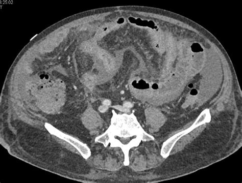 Infected Pancreatic Pseudocyst - Pancreas Case Studies - CTisus CT Scanning