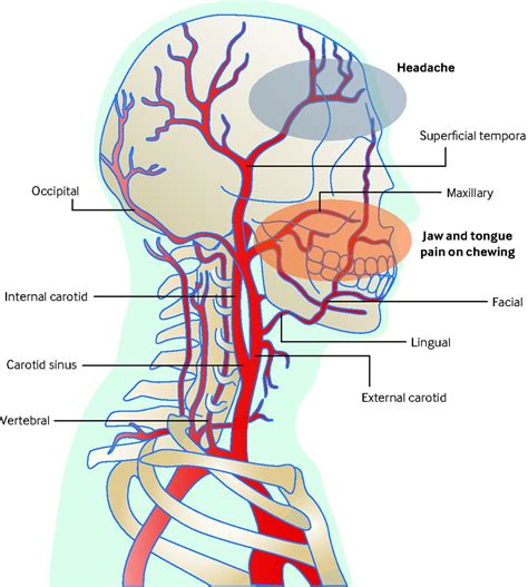 Giant cell arteritis | The BMJ