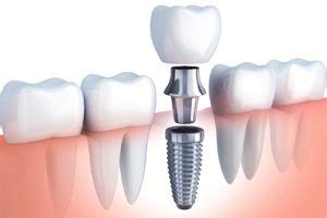 Single Tooth Implant | Oakton Dentistry by Design