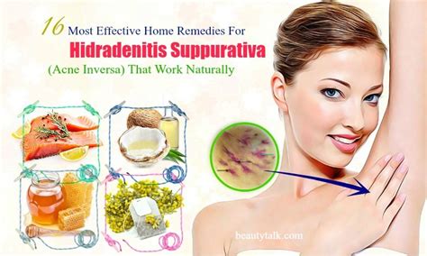 16 Effective Home Remedies For Hidradenitis Suppurativa That Work