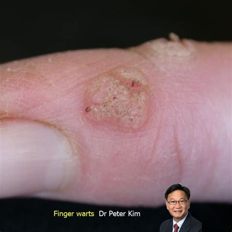 Laser Wart Removal & Treatment Sydney - Finger warts, Plantar warts ...