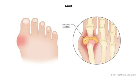 Gout - Symptoms & Causes | Parkway Shenton