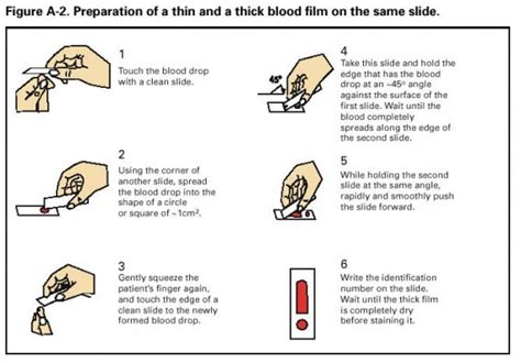 Preparation of a thin and a thick blood film on the same slide ...