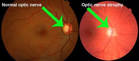 Dominant Optic Atrophy: for patients - Gene Vision