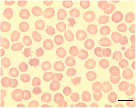 Acanthocytes. Peripheral blood smear showing acanthocytosis in a ...