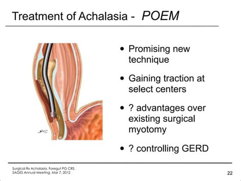 Achalasia Surgery Update 2012 | PPT