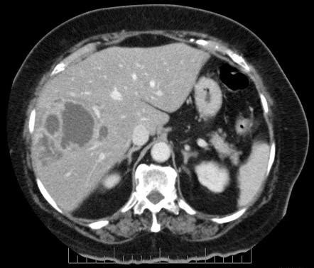 Hepatic abscess | Radiology Reference Article | Radiopaedia.org