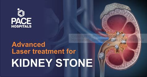 What are Kidney Stones and What are the options for kidney stones treatment?