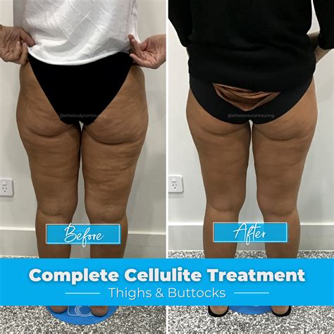 Cellulite Exercises Before And After