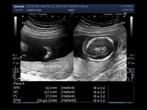 Ultrasound Video showing intrauterine Pregnancy with fetal demise. - YouTube