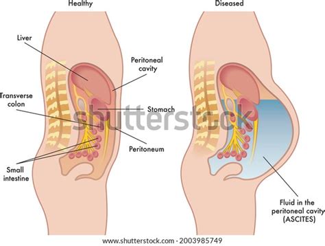 Ascites: Over 143 Royalty-Free Licensable Stock Vectors & Vector Art ...