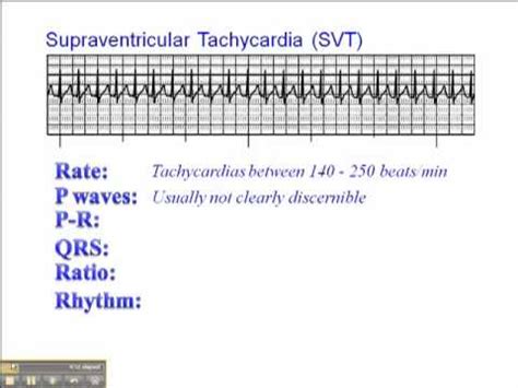 ECG: Supraventricular Tachycardia (SVT) - YouTube