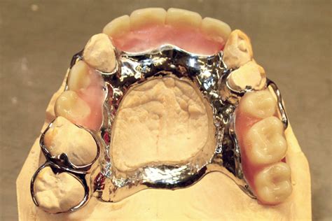 Chrome Dentures available at Cavan Denture Clinic