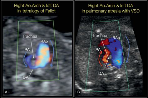 Right Aortic Arch, Double Aortic Arch, and Aberrant Subclavian Artery | Obgyn Key | Ultrasound ...