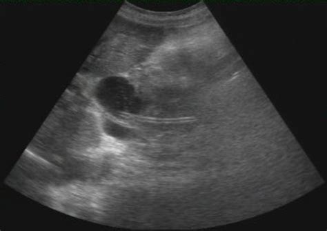 Gallenblase, Ductus Choledochus Stent - DocCheck