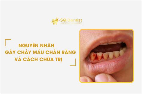 Nguyên Nhân Chảy Máu Chân Răng Và Cách Chữa Trị - Nha Khoa SQ Dentist