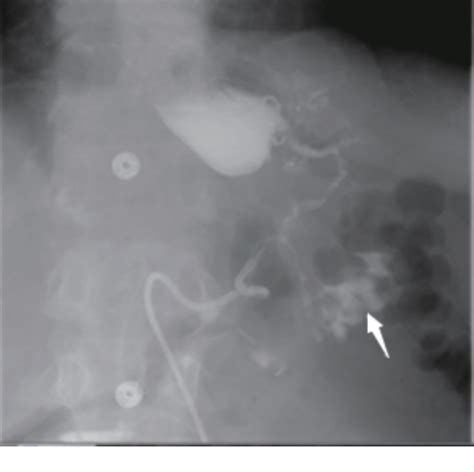 Figure 1 from Gastrocolic Fistula: An Extraordinary Gastrointestinal Fistula | Semantic Scholar