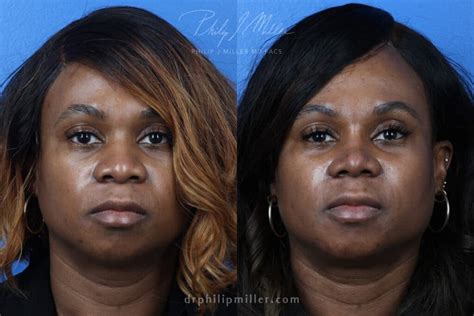 8 Nose Imperfections People Correct with Rhinoplasty - Philip Miller MD