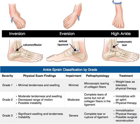 Rosh Review | Sprained ankle, Ankle sprain grades, Ankle