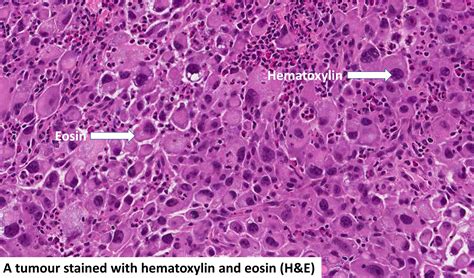 هماتوکسیلین و ائوزین (H&E) | MyPathologyReport.ca