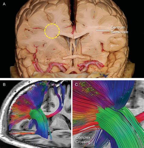 High-Definition Fiber Tractography of the Human Brain: Neuroanatomical Validation and ...