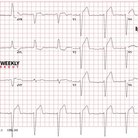 Modified Sgarbossa criteria – ECG Weekly