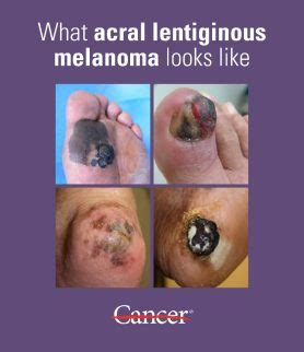 Acral Lentiginous Melanoma Metastatic Melanoma