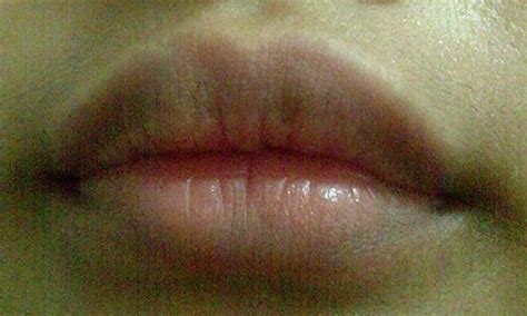 👉 Lip Discoloration - Pictures, Causes, Treatment, Remedies (December 2021)