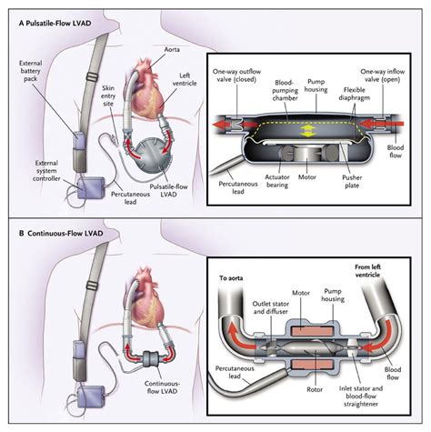 Lvad Heartmate Ii