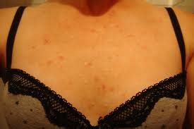 ways to get rid of chest acne: How to Get Rid of Chest Acne