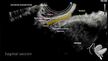 UOG videoclip: Dynamic transvaginal ultrasound examination for ...