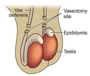 Vasectomy: The “Snip-snip”: St. George Urology & Body Sculpting: Urologists