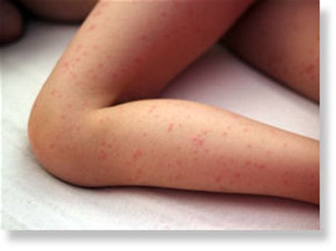 US, Oklahoma: Parents avoid chicken pox vaccine with mail ordered candy -- Society's Child ...