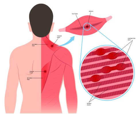 Levator Scapulae Trigger Points