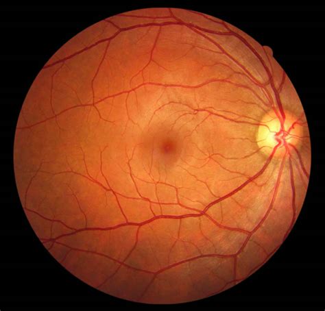 Papilledema causes, symptoms, grades, stages & papilledema treatment