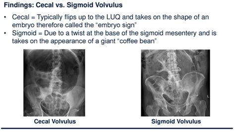 Sigmoid Volvulus Coffee Bean Sign