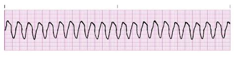 Dr. Smith's ECG Blog: Polymorphic Ventricular Tachycardia